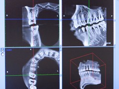 歯科用CTを導入しています