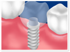 インプラントの術式