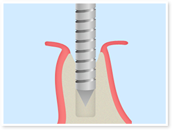 インプラントの術式